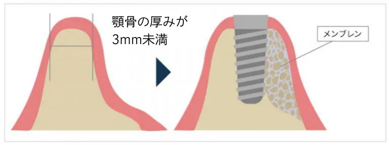 GBR（骨誘導再生）
